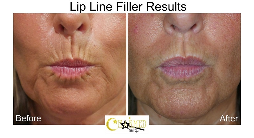 Lip And Smoker Lines Improvement With Natural Looking Results Charmed
