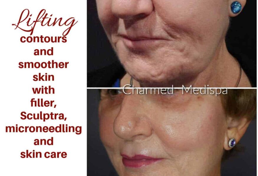 Charmed Medispa Dermal fillers to lift cheeks and smooth skin around the mouth. Microneedling and skin care to improve skin appearance.