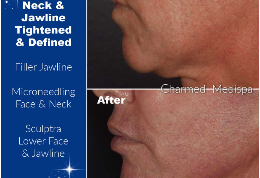 Charmed Medispa Tighten Face Neck