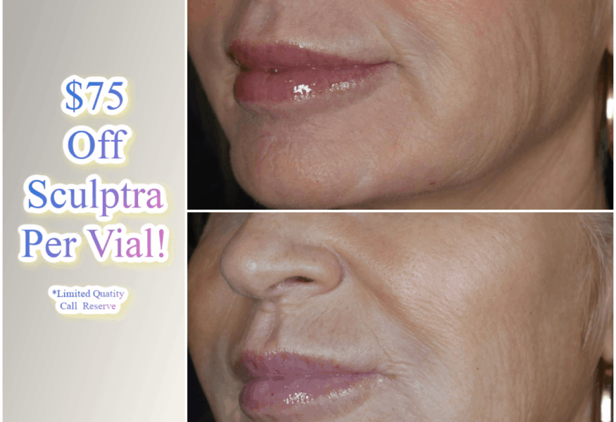 Charmed Medispa Delaware Results of Sculptra in the Lower Face to Smooth Wrinkles