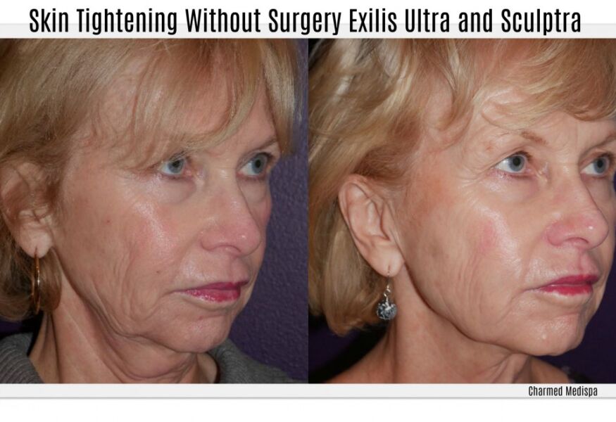 Sculptra to the jaw chin line and smile lines. Notice the crepey skin improvement and lift.