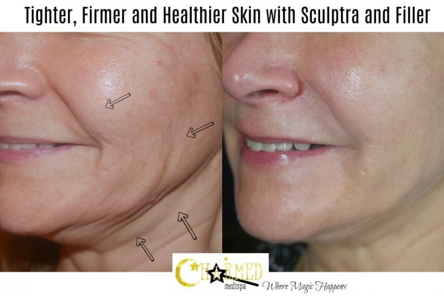 Sculptra is perfect to improve the jowl area and lift the jaw line.