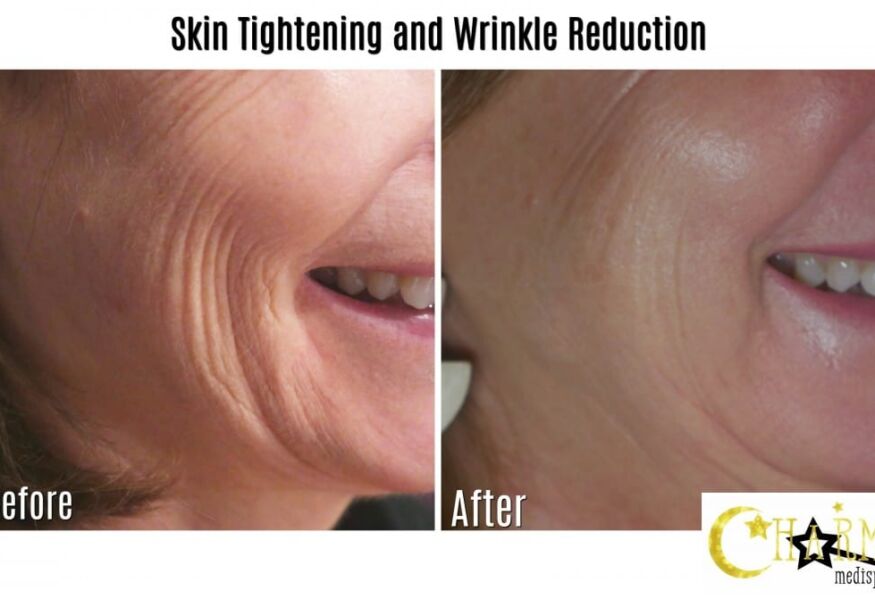 Improve wrinkles and loose skin with Sculptra.