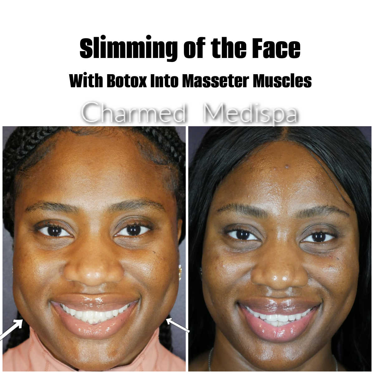 Botox Masseter Muscles To Slim Face And Improve Teeth Grinding – Charmed  Medispa