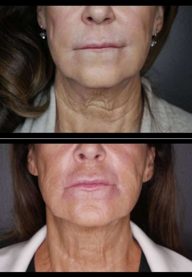 Charmed Medispa Botox Neck Lift Delaware
