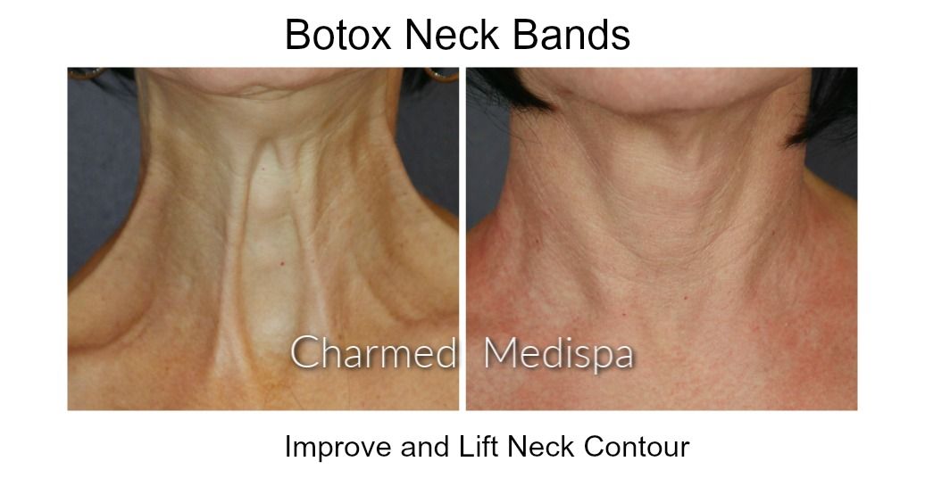 Botox for Submental Fat, Double Chin and the Journey to a Sculpted Neck at  Charmed Medispa – Charmed Medispa