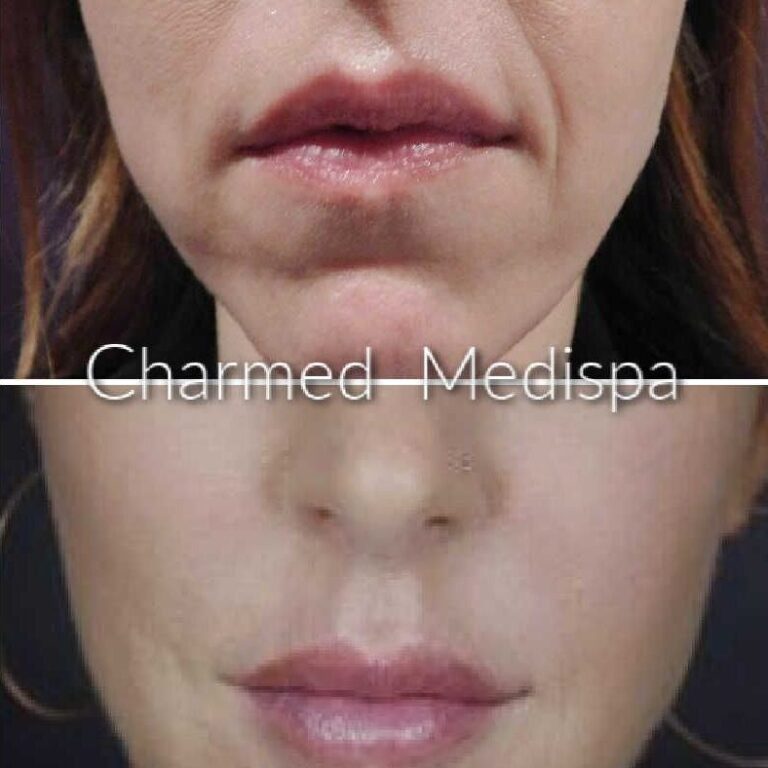 Charmed Medispa Facial Balancing Delaware Filler Sculptra