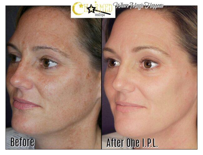 Charmed Medispa IPL Face