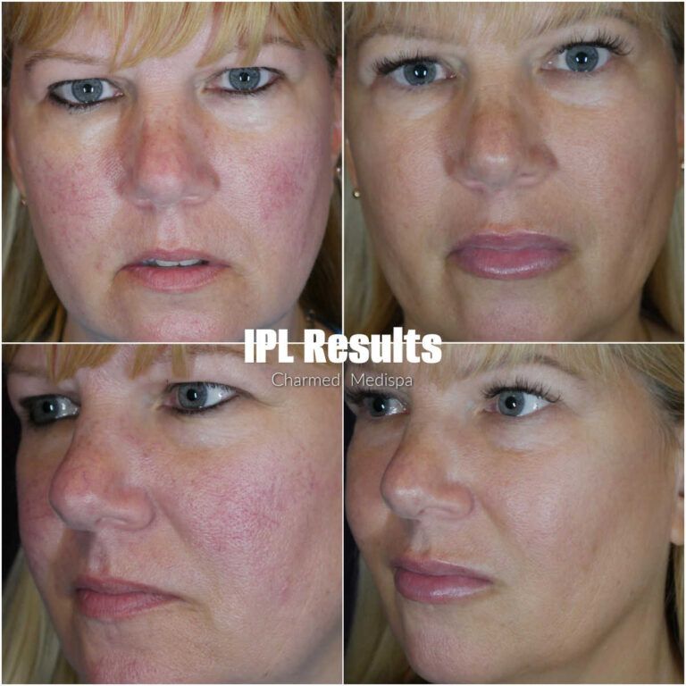 Charmed Medispa IPL Results in Delaware for sun damage and rosecea redness