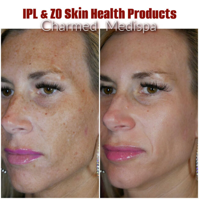 Charmed Medispa IPL ZO Skin Health Results
