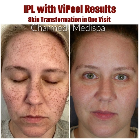 Ipl With Vipeel Results Our Favorite Same Day Treatment Combination