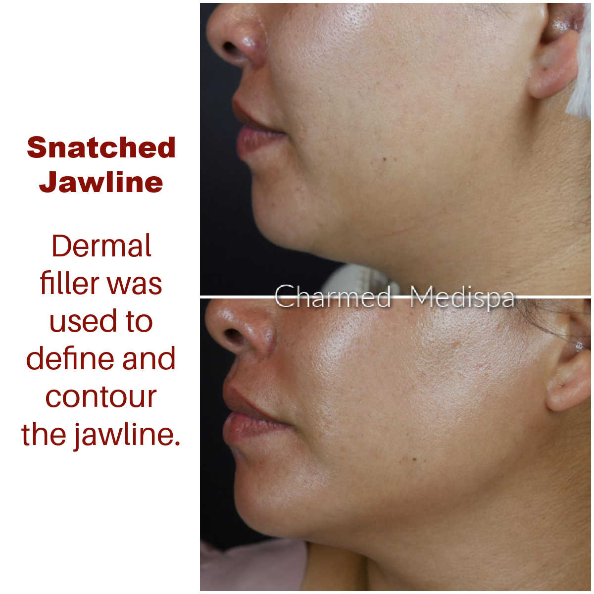 dermal filler