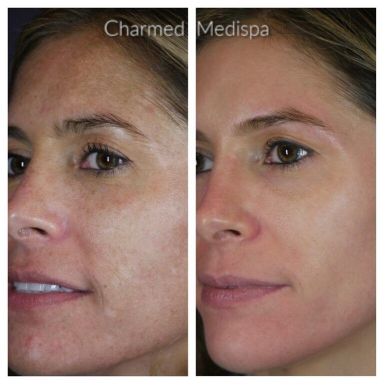 Charmed Medispa Melasma ZO Skin Health