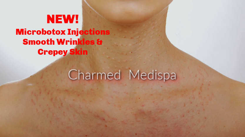 Microbotox Chest And Neck For Wrinkles – Charmed Medispa