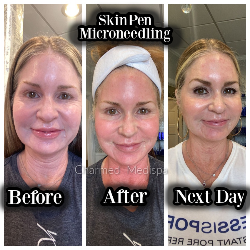 What Does Your Face Look Like After Microneedling?  