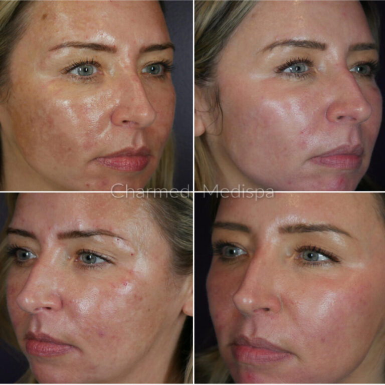Charmed Medispa ZO Skin Pigment Control Program