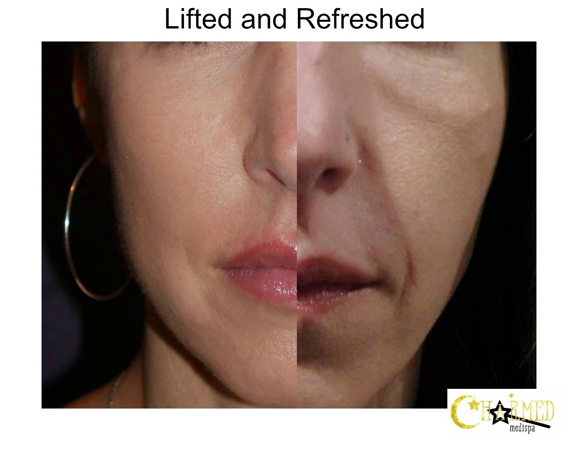 Lifting and Tightening Face Contours – Charmed Medispa