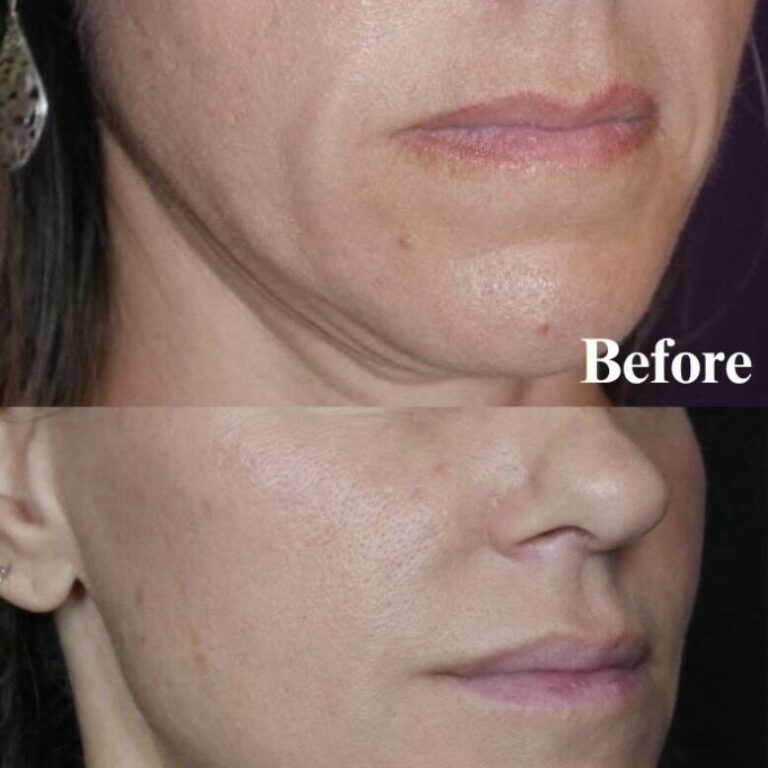 Treatment Folds Jawline Downturn of Mouth Charmed Medispa Newark Delaware