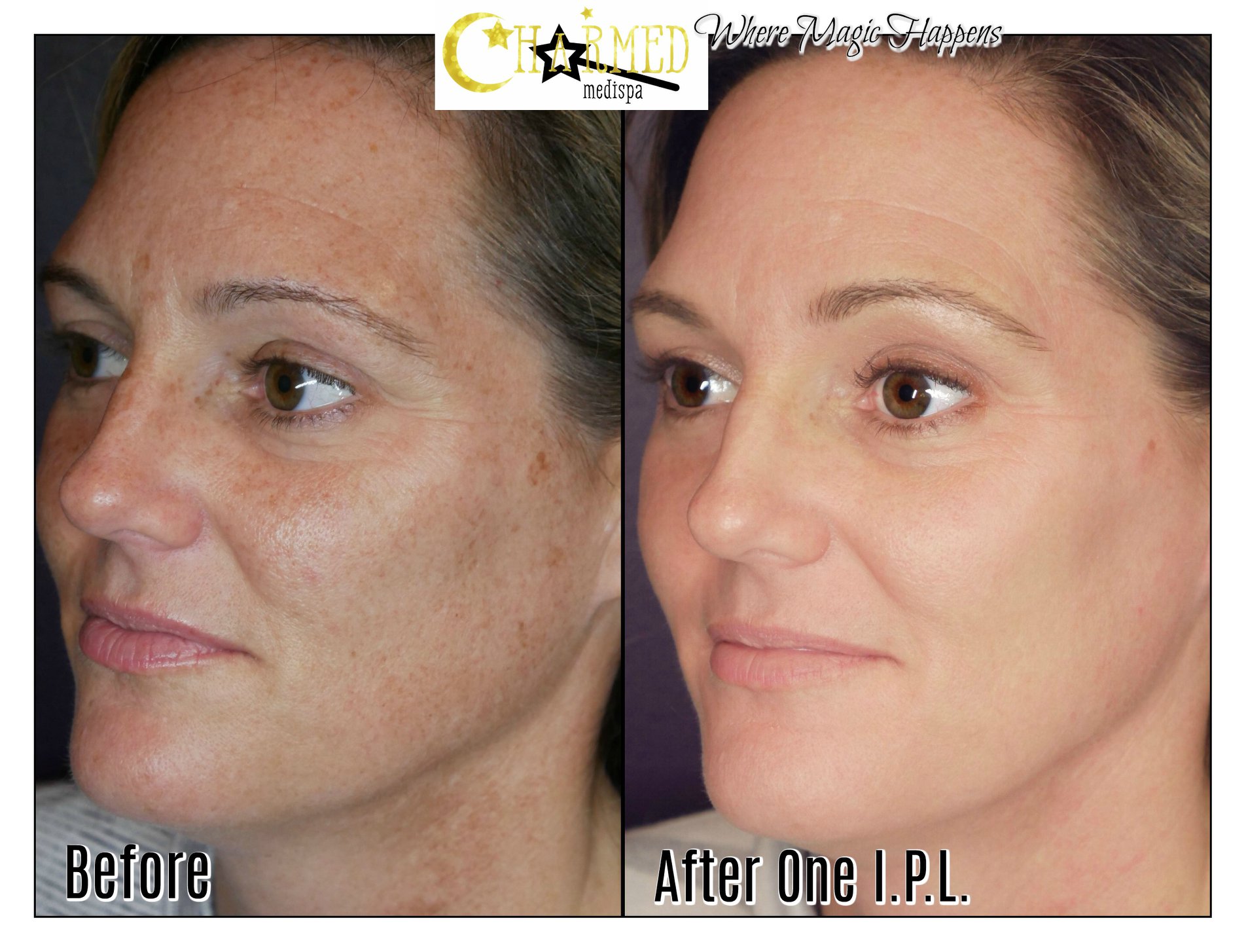 IPL – You Need To Know About Intense Pulsed Light – Charmed