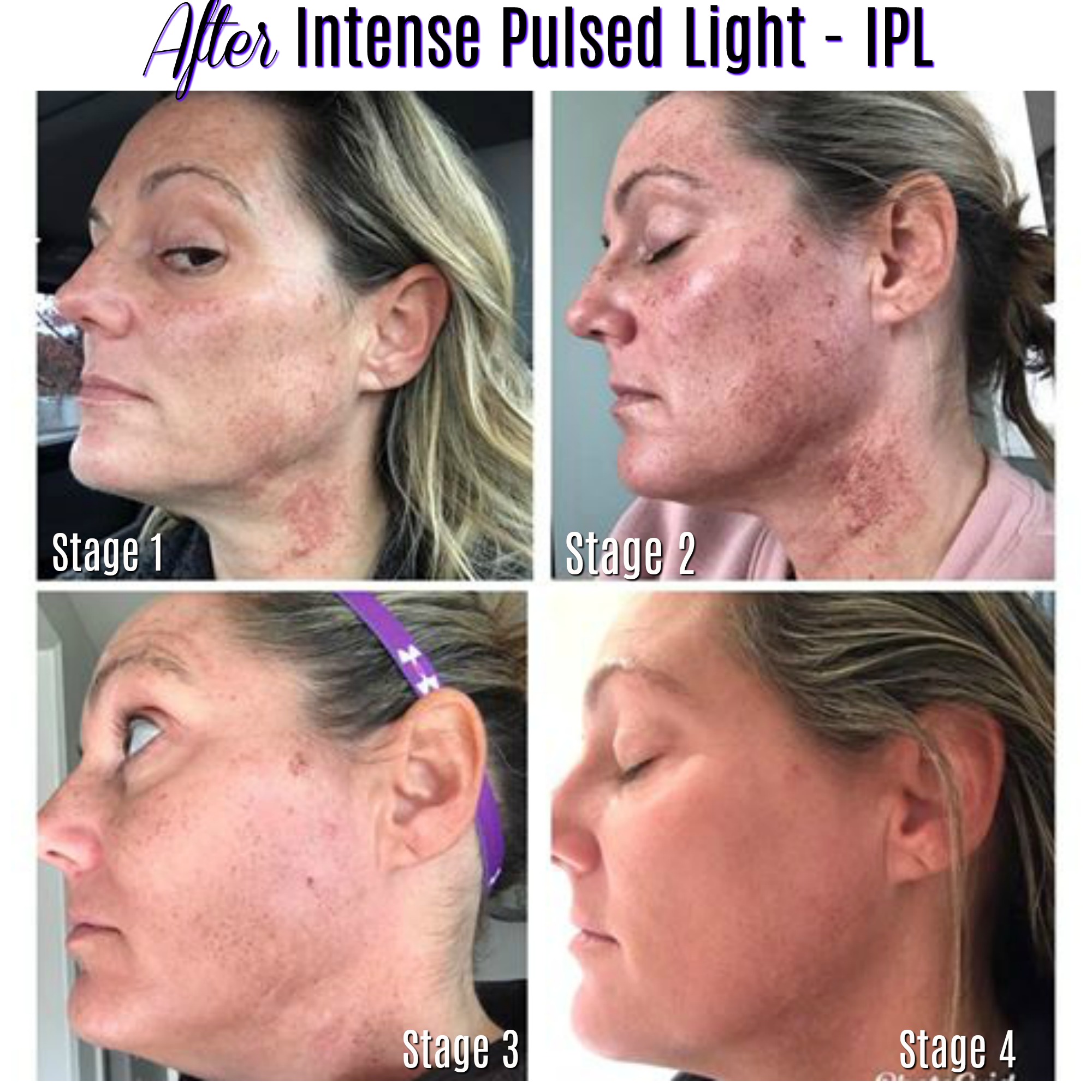 Kemi Røg Site line The IPL Journey – How To Remove Sun Spots and Redness – Charmed Medispa