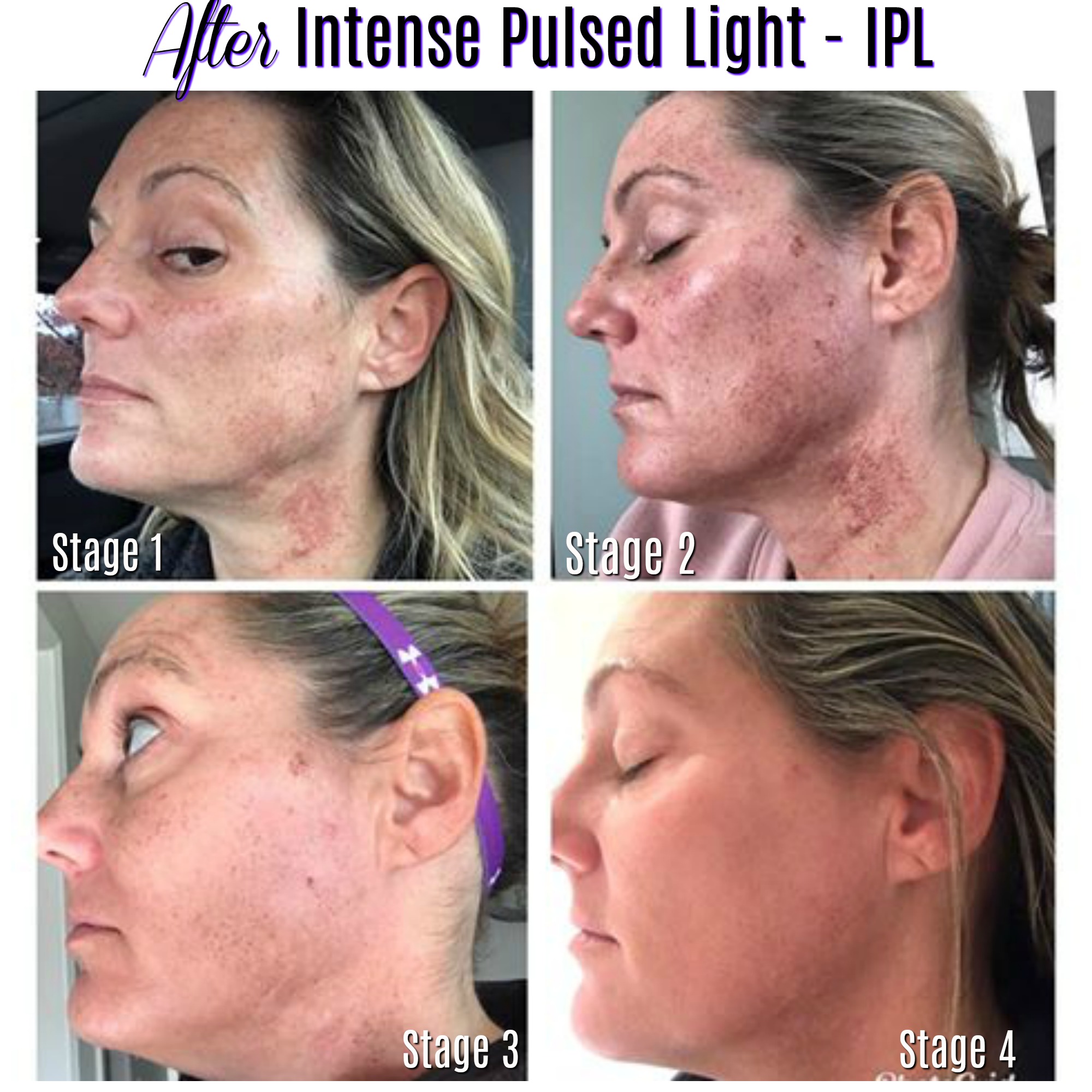 The IPL Journey – How To Remove Sun Spots and Redness – Medispa