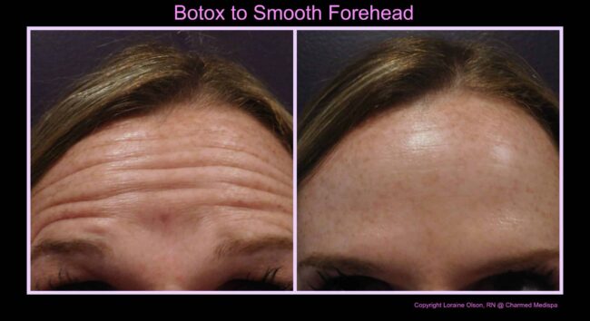 botox delaware med spa