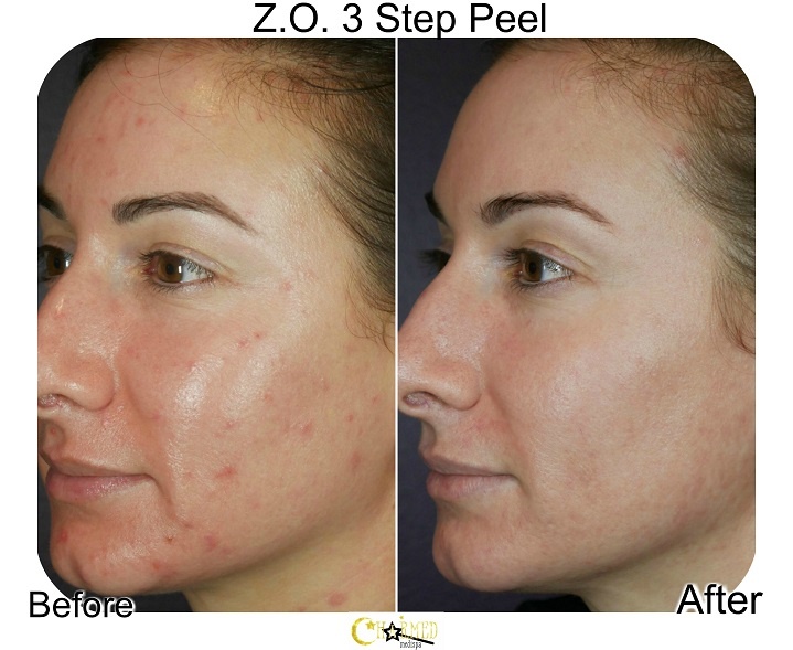 How Often Should You Get a Chemical Peel? - Rejuve Med-Spa