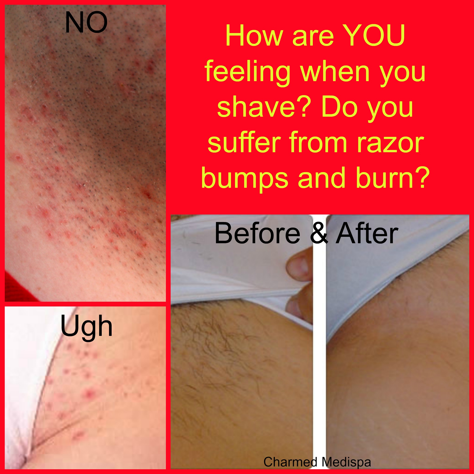 Shave Time With Laser Hair Removal Charmed Medispa