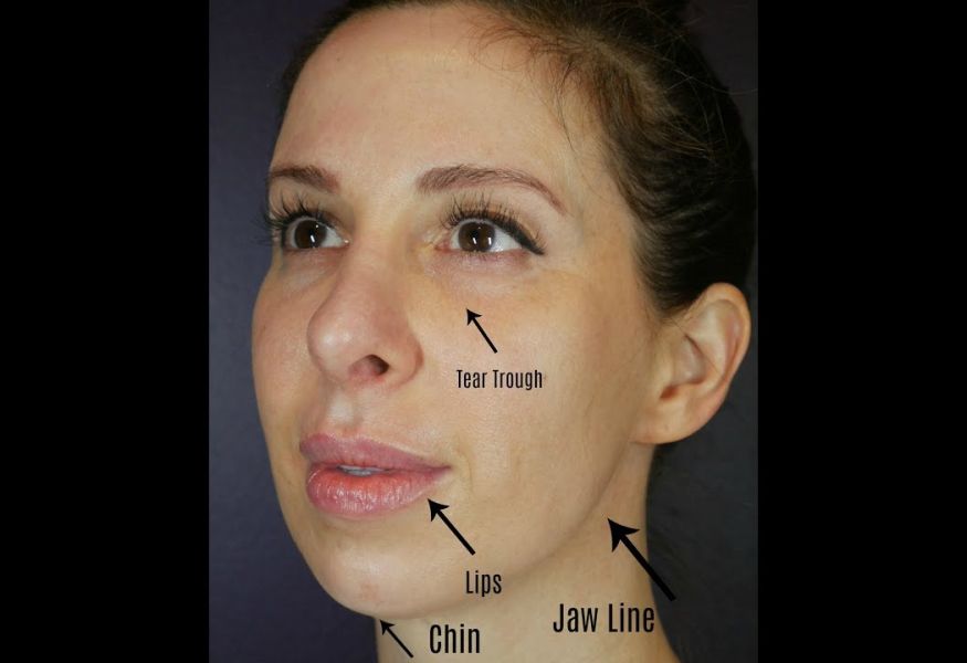 Under Eye Lips Chin Jaw Filler Injection With Results