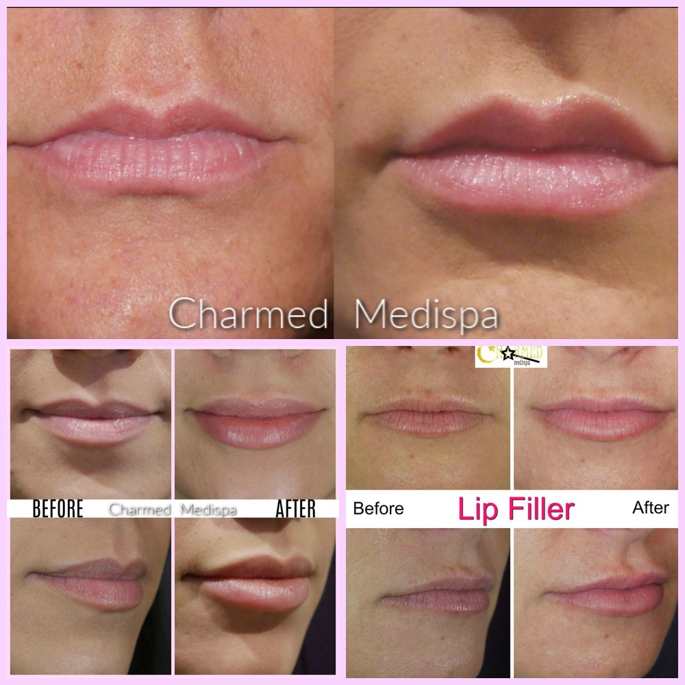 Lip Enhancement with Lip Fillers -Daytona Beach & Palm Coast